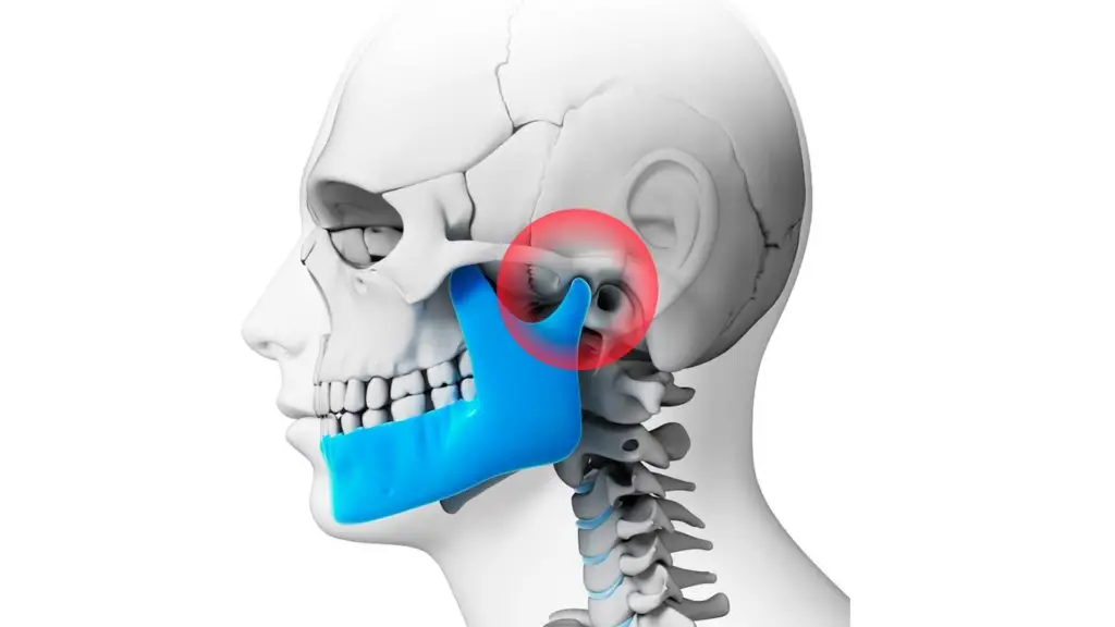 Imagem que mostra a ATM relacionando a distúrbios da articulação temporomandibular.